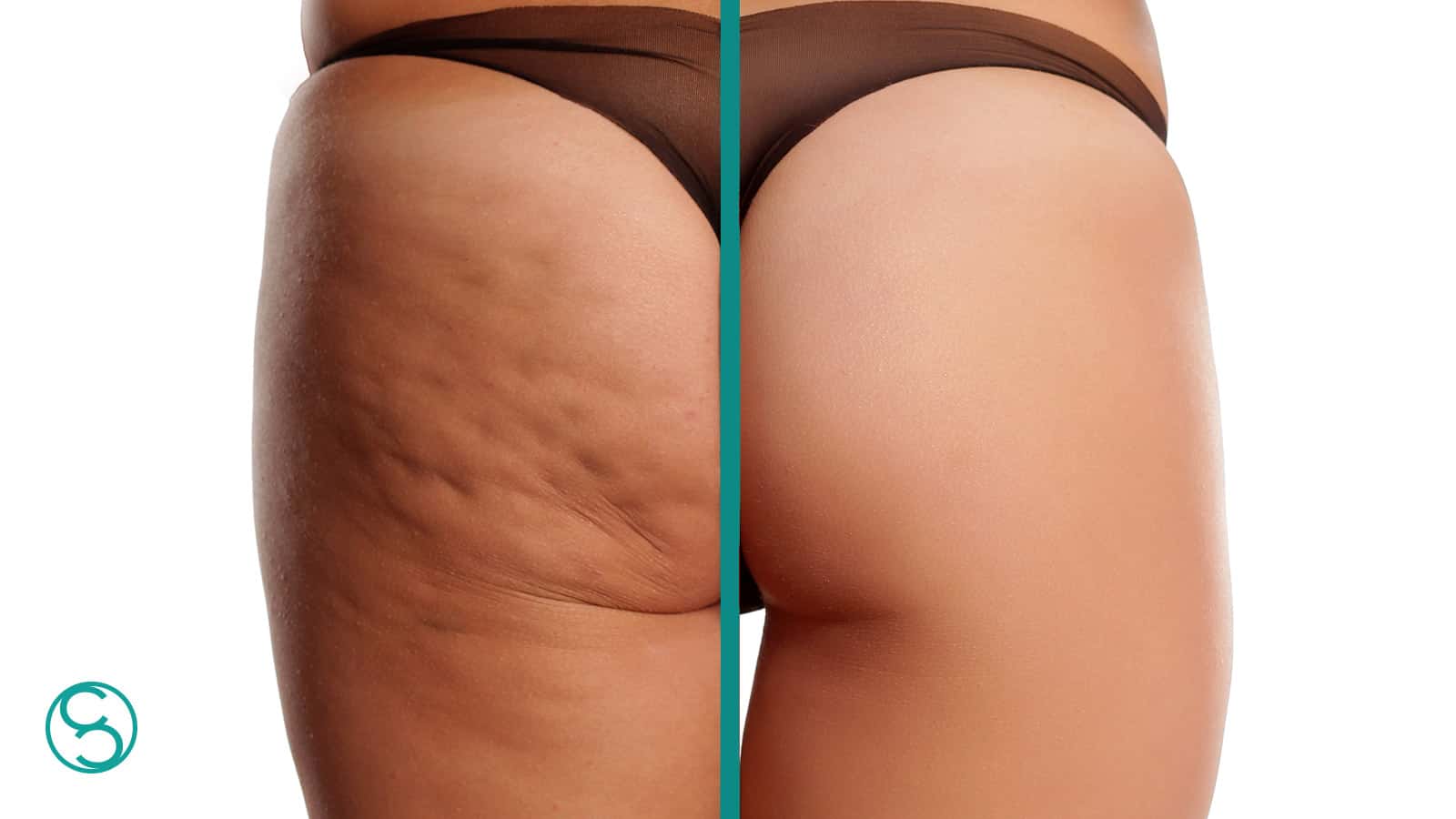 Cellulite? Tutta colpa degli ormoni!